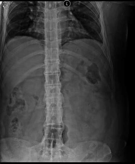 Bamboo Spine on X-ray in a patient with Ankylosing - MEDizzy