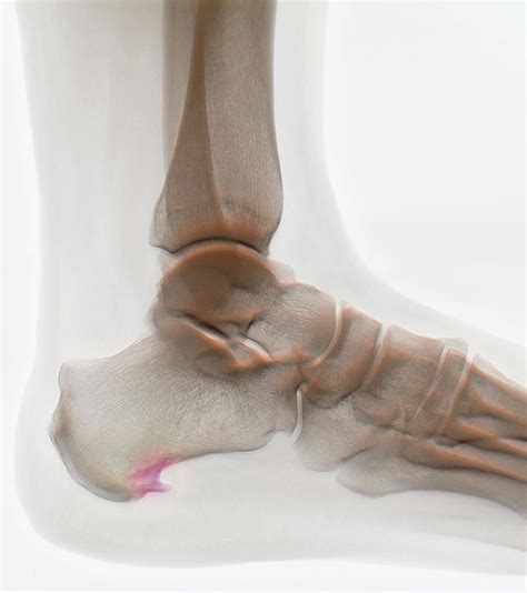 Heel Bone Spur Photograph by Zephyr/science Photo Library - Fine Art ...