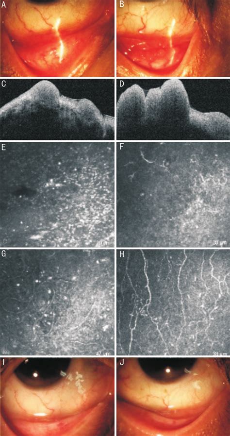 Case 2 A: In right lower fornix conjunctiva, there were some small pink... | Download Scientific ...