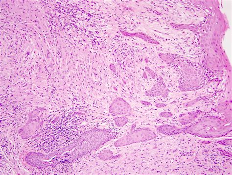 Granular Cell Tumor Histology