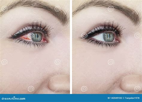 Woman Red Eye before after Treatment Threat Vision Problem Procedures ...