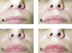 Pimecrolimus Cream 1% is Effective in Seborrhoeic Dermatitis Refractory to Treatment with ...