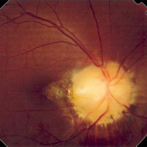 (PDF) Morning glory syndrome associated with multiple sclerosis