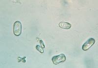 Microscopic Urinalysis Part 2 - Crystals and Casts _ Microscopic ...