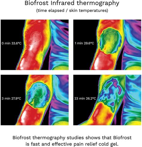 Biofrost Cold Therapy