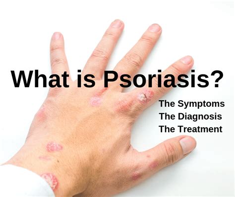 Understanding Psoriasis: Symptoms and Treatment with Medication | Healthy Living Links