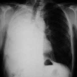 Medicine Notes - Clinical Examination - Pneumonectomy - Medical Zone