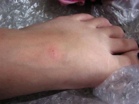 Black Widow Bite Stages - Bumble Bee Sting Pictures, Swelling, Pain, Remedy, Bite ... / Possible ...