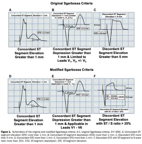 Modified Sgarbossa Criteria for Ventricular Paced Rhythms - JournalFeed