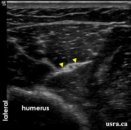 Radial Nerve: Ultrasound Radial Nerve Block At Elbow