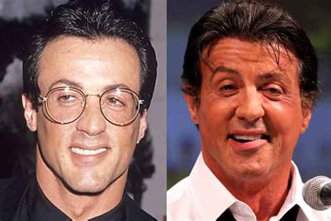 Sylvester Stallone Plastic Surgery: Botox, Nose Job, Baldness