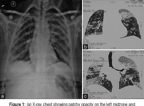 Figure 1 from Cytopathological examination of bronchoalveolar lavage ...