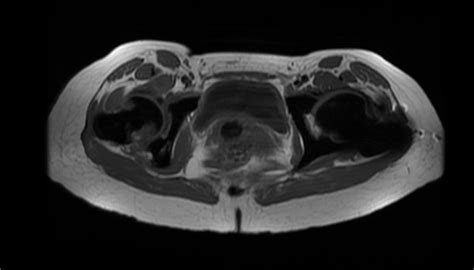 Osteopetrosis - wikidoc