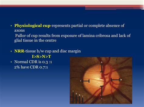 Glaucoma optic disc changes