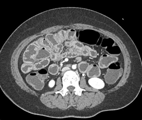 Thickened Small Bowel Loops due to IBD - Small Bowel Case Studies - CTisus CT Scanning