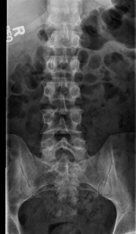 Low Back Pain – Undergraduate Diagnostic Imaging Fundamentals