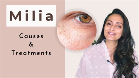 Milia | What is milia | Causes| Treatment | dermatologist | Dr. Aanchal Panth - YouTube