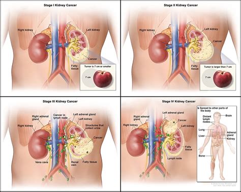 Kidney Cancer | Rocky Mountain Cancer Centers