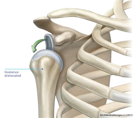 Shoulder Dislocation - Joint Preservation Center