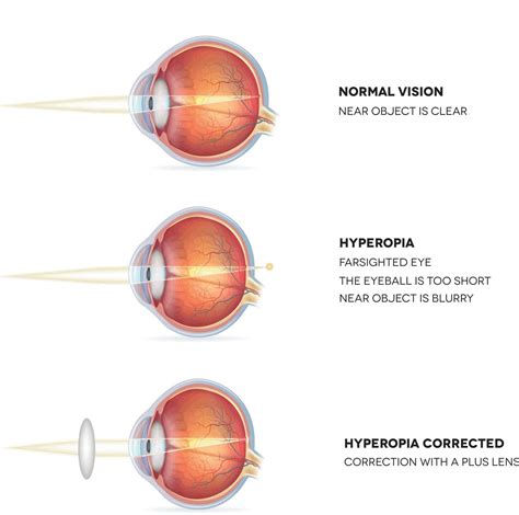 Farsightedness (Hyperopia) - Symptoms, Causes & Treatment