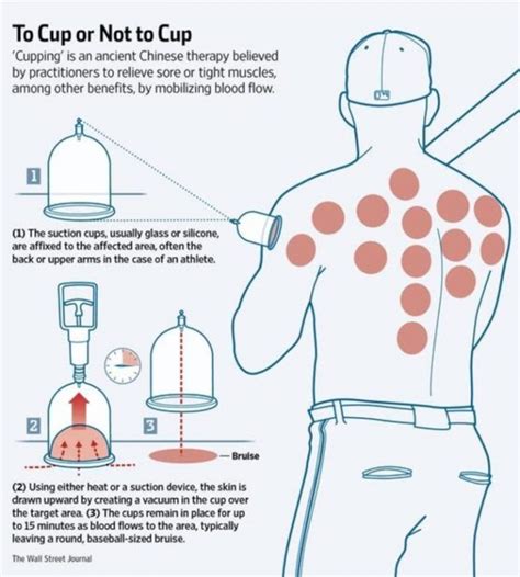 PHYXIT Physio and Injury Clinic | MASSAGE MONDAY – Cupping explained