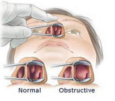 nasal obstuction - Fort Worth ENT & Sinus