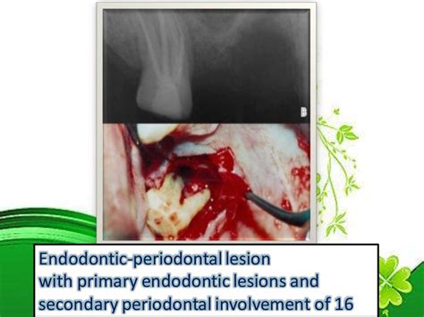 Endo perio lesions