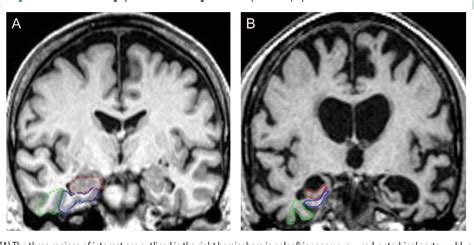 Figure 1 from Medial temporal lobe atrophy on MRI scans and the diagnosis of Alzheimer disease ...