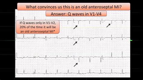 ECG#3 Anteroseptal MI - YouTube