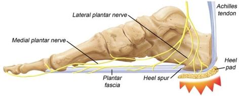 PLANTAR FASCIITIS (HEEL PAIN) - UDAI OMNI HOSPITAL