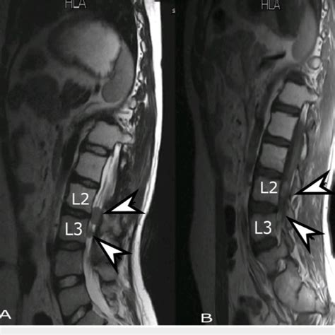 MRI whole spine, sagittal view. (A) T2 weighted and (B) T1 weighted... | Download Scientific Diagram