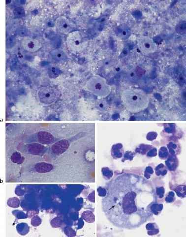 Cytology of the Respiratory System Especially Bronchoalveolar Lavage - Hematology