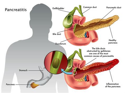 Chronic pancreatitis Guide: Causes, Symptoms and Treatment Options