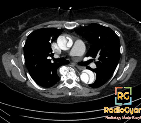 Aortic Dissection | Radiology Reference Article - RadioGyan