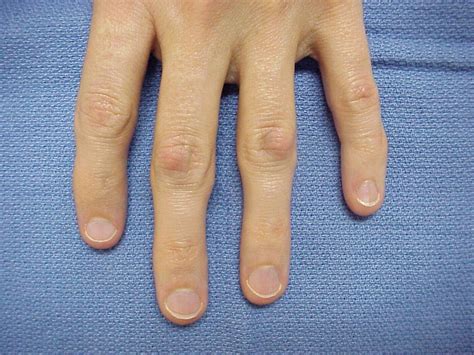 Dupuytren's: Knuckle Pads: Dorsal Dupuytren Nodules