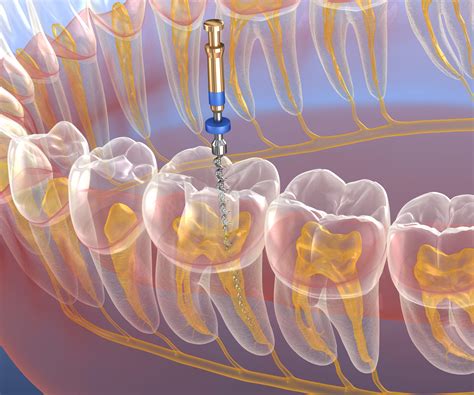 Endodontic root canal treatment process. Medically accurate tooth 3D illustration. - LVI Global