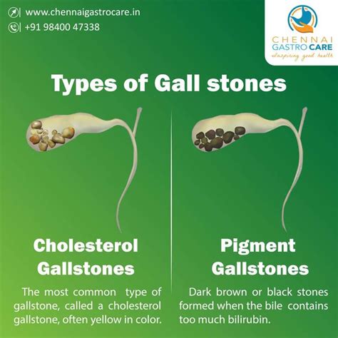 Gallstone Types - Chennai Gastro Care | Gallstones, Gallstones symptoms, Bladder