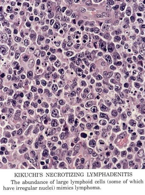 Pathology Outlines - Kikuchi disease