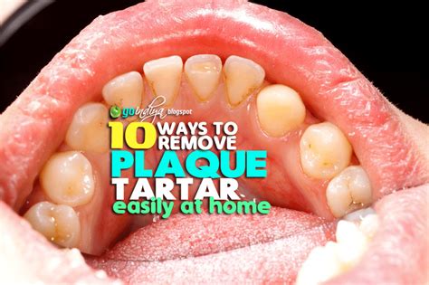 10 Easy Ways to Remove Plaque and Tartar from Teeth At Home Naturally ...