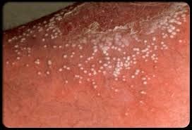 Psoriasis | Myskinclear.com