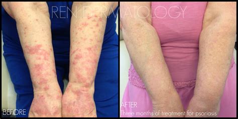 Psoriasis – REN Dermatology