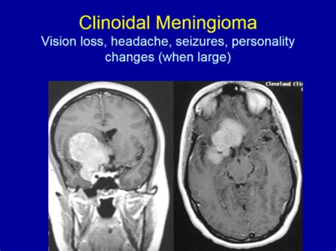 Clinoidal Meningioma | Hot Sex Picture