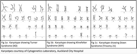 What is Aneuploidy - The University of Auckland