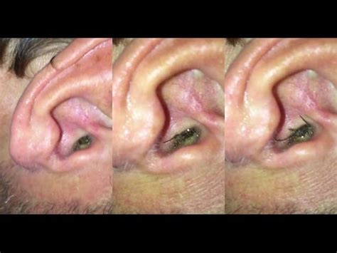 10 DISGUSTING INSECTS FOUND IN PEOPLE'S EARS!!!!!🐛😱😰 - YouTube