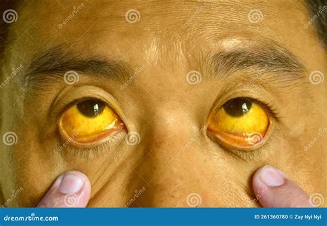 Deep Jaundice In Asian Male Patient. Yellowish Discoloration Of Skin And Sclera ...