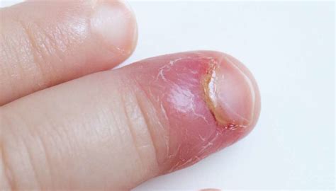 Paronychia: Causes and treatment of an infected nail