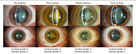 Cortical Cataract and Refractive Error | Semantic Scholar