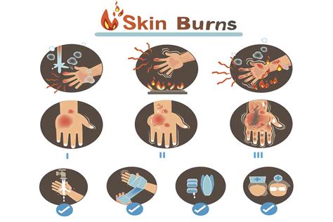 First Aid For Burns: How to Treat and Heal Every Type of Burn - FamilyEducation