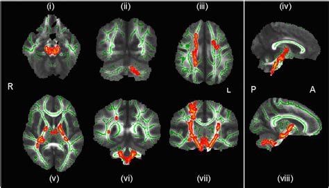 Regions of significantly increased fractional anisotropy in conduct... | Download Scientific Diagram