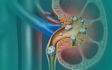 Kidney Stones & Bladder Infections